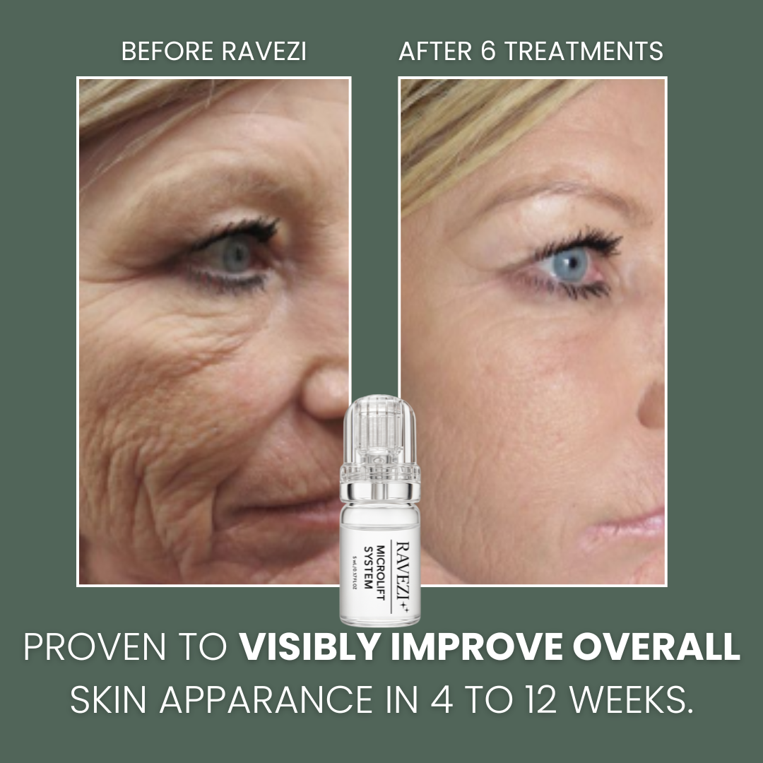 Micro-Infusion Facial System